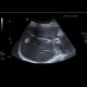 Liver hemangioma: US - Ultrasound